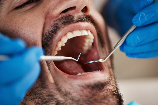 Best Emergency Dentist for Lost Fillings or Crowns in Teaticket, MA
